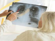 Search and Compare the Best Clinics and Doctors at the Lowest Prices for Lung Biopsy in Thailand