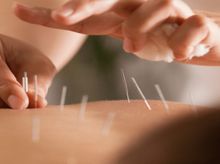 Search and Compare the Best Clinics and Doctors at the Lowest Prices for Acupuncture in Vietnam