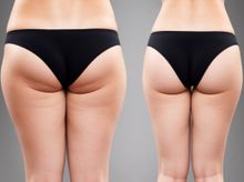Search and Compare the Best Clinics and Doctors at the Lowest Prices for Thigh Liposuction in Mexico