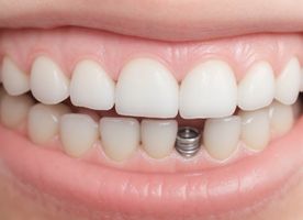 Trồng răng Implant nha khoa