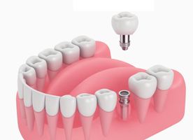 Dental Implant Bars