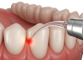 Điều trị bệnh nướu răng bằng laser