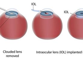 Cấy ghép thấu kính nội nhãn (IOL)