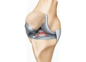 Operasi Ligamen Lutut (ACL)