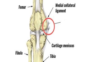 Knee Ligament Surgery (MCL)