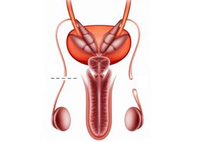 Reverse Vasectomy