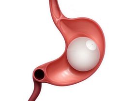 Search and Compare the Best Clinics and Doctors at the Lowest Prices for Gastric Balloon Treatment in Philippines