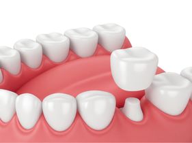 Search and Compare the Best Clinics and Doctors at the Lowest Prices for Dental Crown in Vietnam