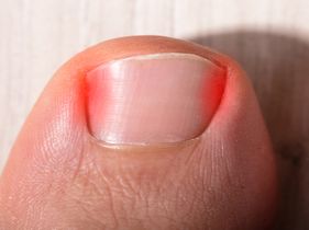 Search and Compare the Best Clinics and Doctors at the Lowest Prices for Ingrown Toenail Treatment in Philippines