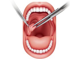 Search and Compare the Best Clinics and Doctors at the Lowest Prices for Tonsillectomy in Czech Republic