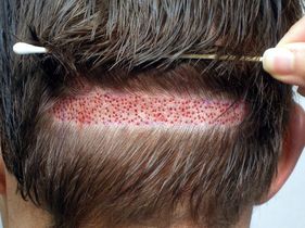 Search and Compare the Best Clinics and Doctors at the Lowest Prices for Hair Implant in Thailand