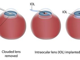 Search and Compare the Best Clinics and Doctors at the Lowest Prices for Intraocular Lens (IOL) Implant in Poland