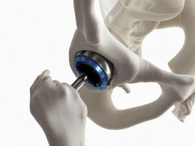Search and Compare the Best Clinics and Doctors at the Lowest Prices for Hip Replacement in South Korea