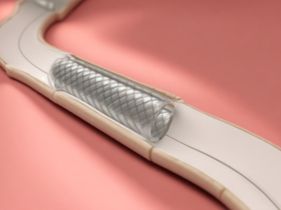 Search and Compare the Best Clinics and Doctors at the Lowest Prices for Angioplasty in Philippines