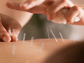 Search and Compare the Best Clinics and Doctors at the Lowest Prices for Acupuncture in Thailand