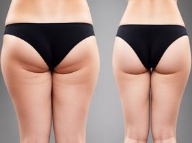 Bandingkan Harga, Biaya & Ulasan untuk Thigh Liposuction di Indonesia