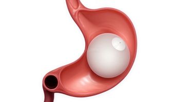 Compare Prices, Costs & Reviews for Gastric Balloon Treatment in United Arab Emirates