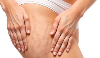 Search and Compare the Best Clinics and Doctors at the Lowest Prices for Cellulite Treatment in United Kingdom
