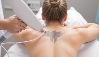 Compare Prices, Costs & Reviews for Laser Tattoo Removal in Russian Federation