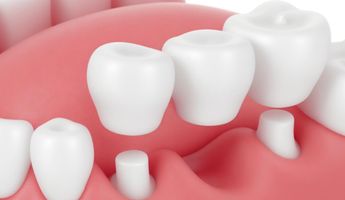 Compare Prices, Costs & Reviews for Dental Bridge in Indonesia