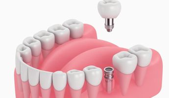Search and Compare the Best Clinics and Doctors at the Lowest Prices for Dental Implant Bars in West Sussex