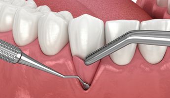 Search and Compare the Best Clinics and Doctors at the Lowest Prices for Gum Tissue Graft in Belgium