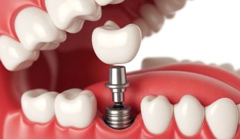 Search and Compare the Best Clinics and Doctors at the Lowest Prices for Mini Dental Implant in West Lothian