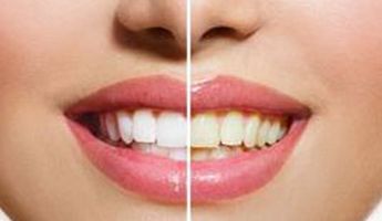 Search and Compare the Best Clinics and Doctors at the Lowest Prices for Veneers in Essex