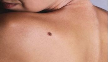 Compare Prices, Costs & Reviews for Mole Removal in Germany