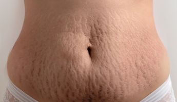 Compare Prices, Costs & Reviews for Stretch Marks Removal in Romania