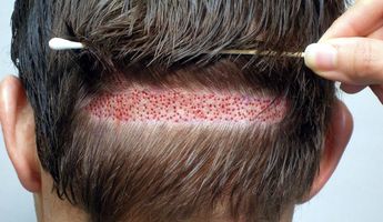 Compare Prices, Costs & Reviews for Hair Implant in Turkey