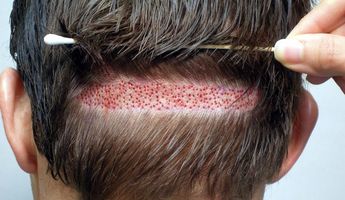 Search and Compare the Best Clinics and Doctors at the Lowest Prices for Hair Implant in Bangalore