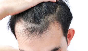 Compare Prices, Costs & Reviews for Hair Loss Treatment in Vietnam
