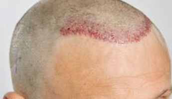 Search and Compare the Best Clinics and Doctors at the Lowest Prices for Hair Transplant in Isle of Wight