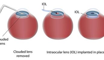 Compare Prices, Costs & Reviews for Intraocular Lens (IOL) Implant in Al Wosta