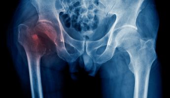 Compare Prices, Costs & Reviews for Hip Fracture Surgery in Croatia