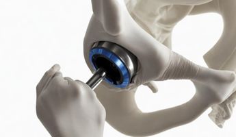 Compare Prices, Costs & Reviews for Hip Replacement in Central Velke Mezirici