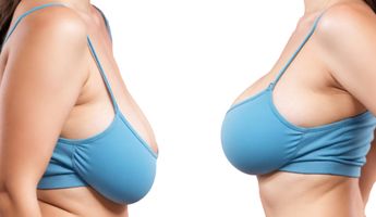 Search and Compare the Best Clinics and Doctors at the Lowest Prices for Breast Lift in Istanbul