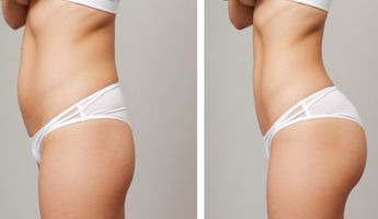 Compare Prices, Costs & Reviews for Fat Transfer in Cologne