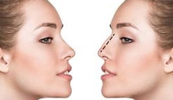 Search and Compare the Best Clinics and Doctors at the Lowest Prices for Rhinoplasty in Rizal
