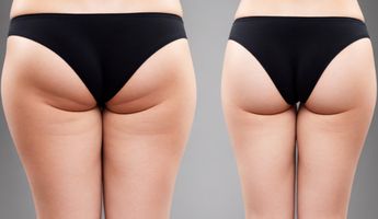 Compare Prices, Costs & Reviews for Thigh Liposuction in Vietnam