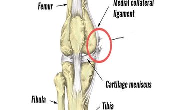 膝关节韧带手术 ( MCL )