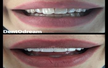 Compare Reviews, Prices & Costs of Dentistry Packages in Antalya at DentOdream / Dental Dream Turkey | M-TU2-7