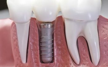 Compare Reviews, Prices & Costs of Dentistry in Bangalore at Pranam Dental and Implant Center -Majestic,Bangalore | M-IN1-7