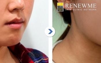 Compare Reviews, Prices & Costs of Plastic and Cosmetic Surgery in South Korea at Renewme Skin Clinic Dongdaemun | M-SO8-32
