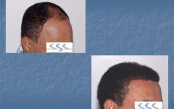 Compare Reviews, Prices & Costs of Hair Restoration in Santo Domingo at Hair Transplant Institute - Dr. Alba Reyes, MD | M-DO1-9
