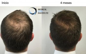 对比关于Medical Hair Institute提供的 位于 Carrer del Dr Roux头发修复的评论、价格和成本| M-SP4-37