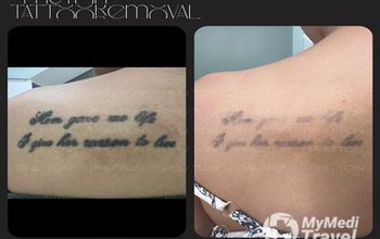 Compare Reviews, Prices & Costs of General Medicine in Hong Ngu at PHU TON - Laser Tattoo Removal | B3369E