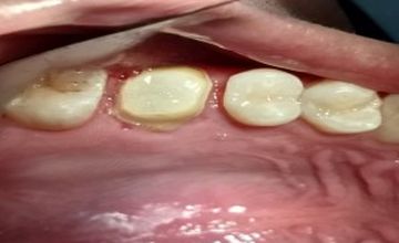 Compare Reviews, Prices & Costs of Dentistry Packages in Ciudad Juarez at Duo Dental Care | M-ME2-2