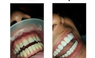 Compare Reviews, Prices & Costs of Dentistry in Colombia at Sonrisa Perfecta Dental-Tarsys Loayza Roys | M-CO-1-3